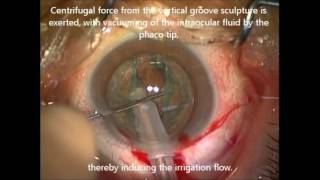 iH during phacoemulsification cataract surgery - ID 124528