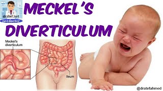 Meckel's Diverticulum /Meckel's Diverticulum Surgery/ Management of Symptomatic Meckel's Diverticula