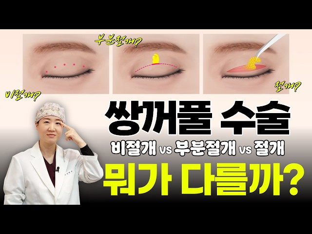 쌍꺼풀 수술, 이 영상으로 종결! 나한테 맞는 쌍꺼풀 수술 방법은?