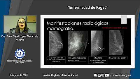 ¿Aparece la enfermedad de Paget en una mamografía?