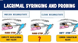 Lacrimal Syringing and Probing : Technique and Interpretation of results screenshot 4