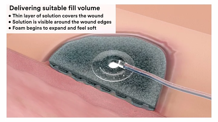 3M™ V.A.C.® Ulta Therapy System 4 Therapy System Video