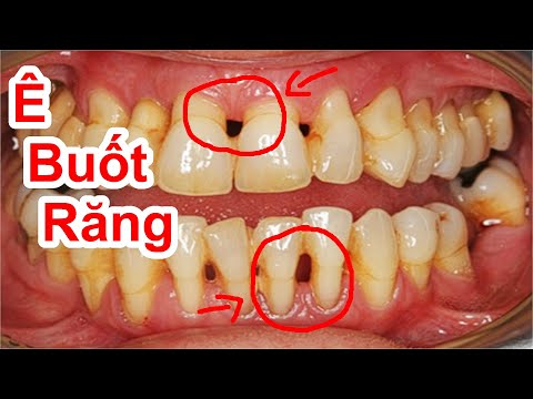 Cách Hết Ê Buốt Chân Răng - Hết Tuột Nứu Răng Hiêu Quả Ngay Tại Nhà / Mẹo Làm Hết E Buốt Răng