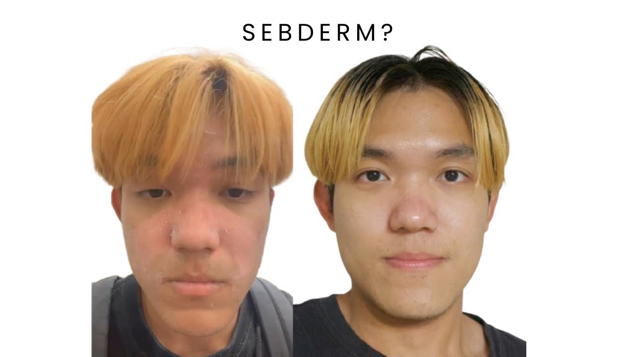 Struggling with Seborrheic Dermatitis? Here’s How I Fixed Mine in Japan