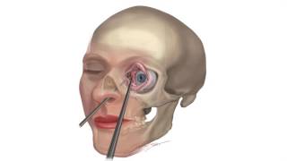 Combined Transconjunctival and Endoscopic Endonasal Approach from Video Atlas of Neurosurgery screenshot 2