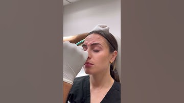 Before and after Botox Injections