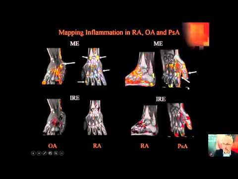 Video: Prediksi Patologi Amiloid Pada Individu Yang Tidak Mengalami Gangguan Kognitif Menggunakan Analisis Voxel-bijaksana Dari MRI Otak Struktural Memanjang