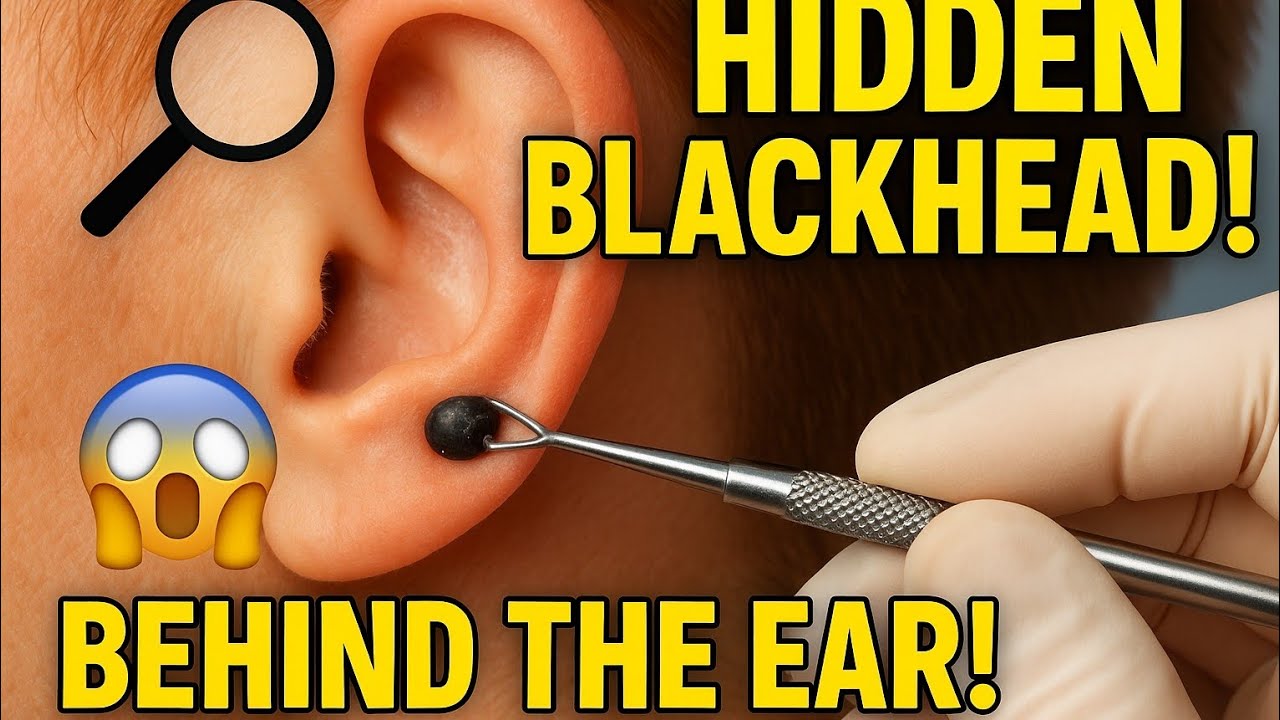 Satisfying Blackhead Extraction Behind the Ear YouTube
