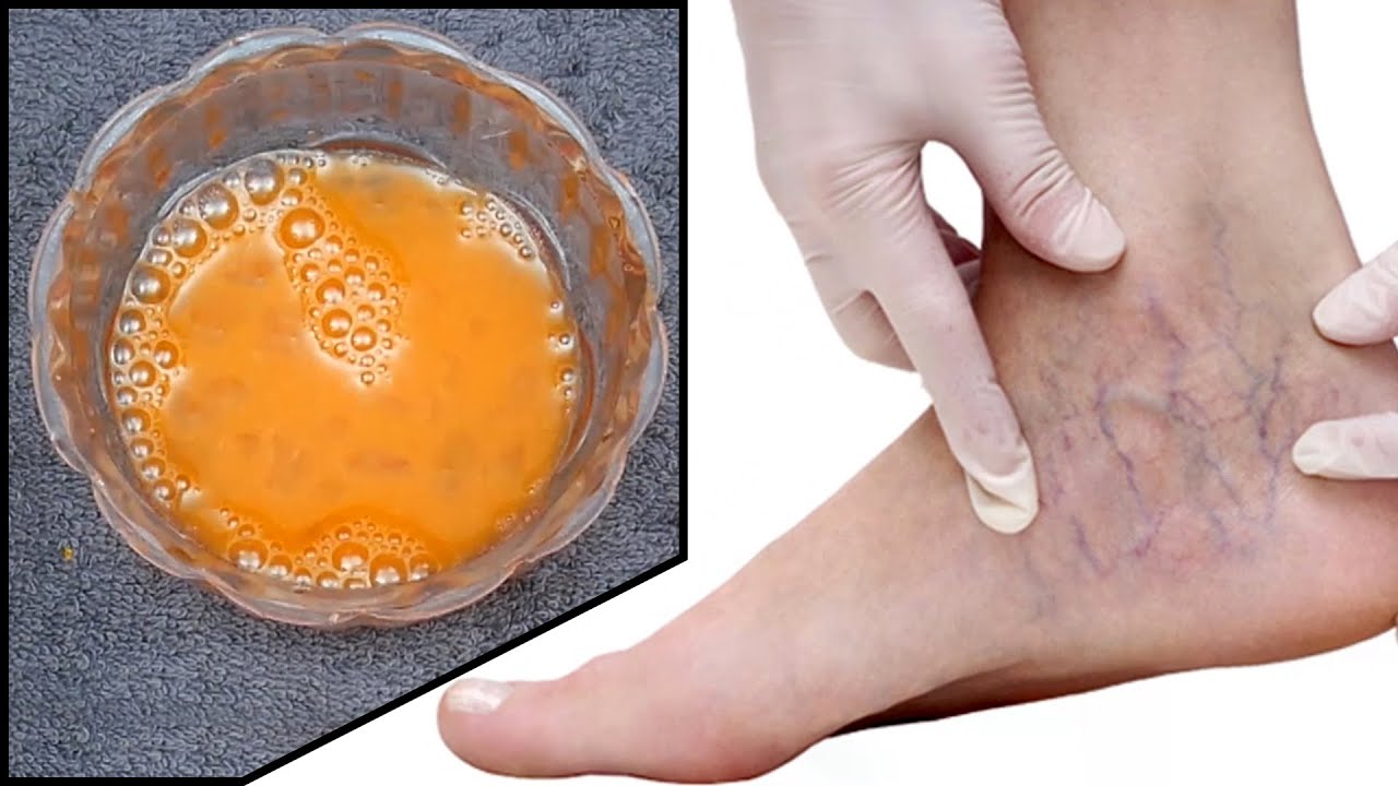 Cure Varicose Veins with this NATURAL REMEDIES Health and Safety