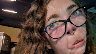 Surgery #30 was CANCELLED 