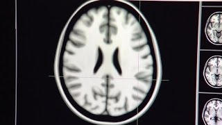 Heavy teen marijuana use may cause memory problems