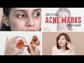 Dermatological Treatments For ACNE MARKS