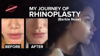 Rhinoplasty Surgery for Barbie Nose | Before and After Result | Cosmetic Surgery in Mumbai