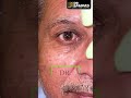 Blackheads &amp; White Heads  Solution | Dr Lalit Kasana - skin Treatment