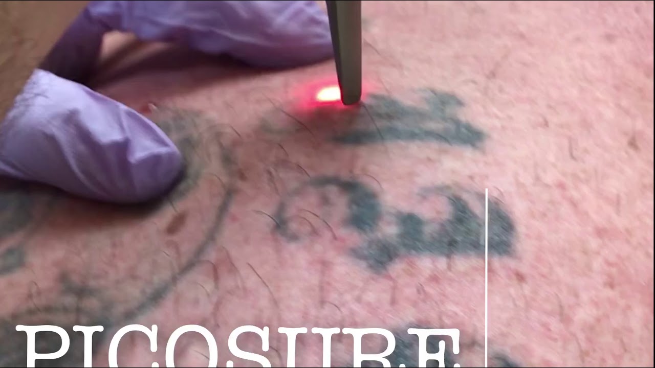 PICOSURE TATTOO REMOVAL LASER -KAADO MD