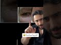 ودع تجاعيد تحت العين للأبد جلسة واحدة دكتور يوسف 