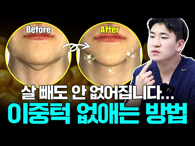 대부분이 모르는 살 빼도 이중턱 안 없어지는 이유 | 저스트성형외과