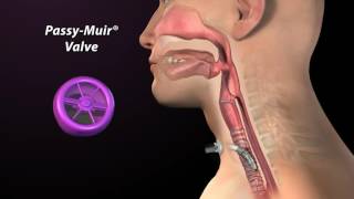 Cuff Deflation and Placement of the Passy Muir Valve