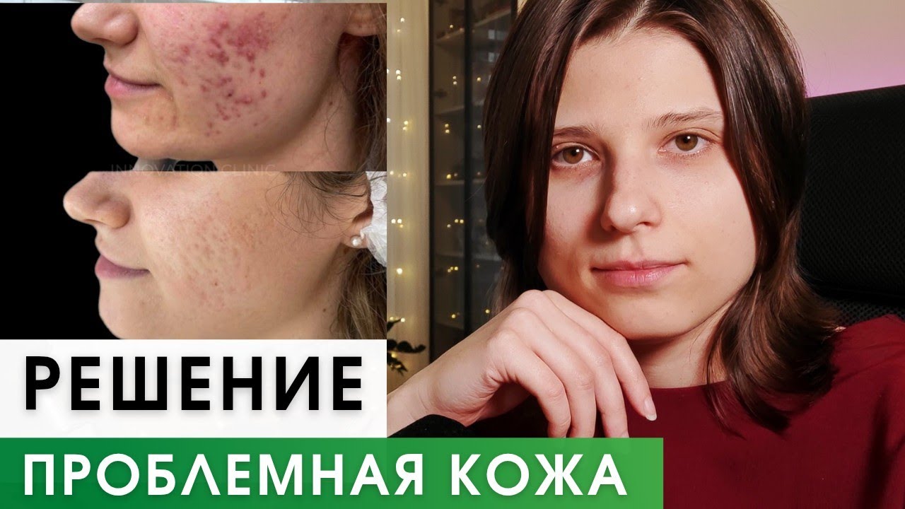 Акне, Прыщи и Проблемная Кожа. КАК ИЗБАВИТЬСЯ. Программа сибирское здоровье