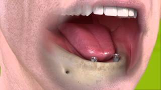 Complete tooth replacement with a removable implant bar supported denture