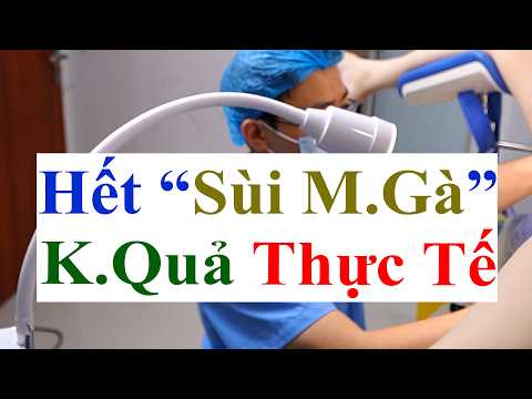 Kết Quả Thực Tế Trước & Sau Điều Trị Sùi Mào Gà Bằng Đốt Điện Chuyên Biệt Tại PK Bs Sắc Việt Đức