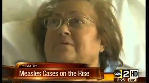 Measles cases on the rise