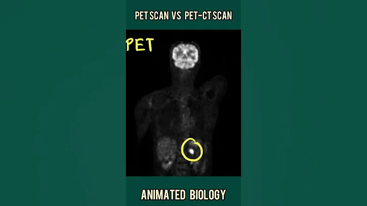PET Scan vs PET-CT scan in 1 minute | How PET scan can detect cancer? - 天天要闻