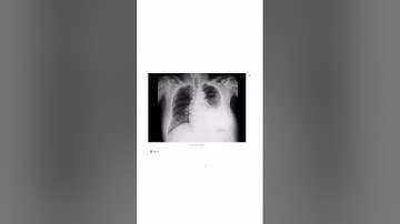 I Built An AI Chest X-ray Reporting Tool