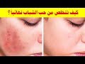 كيف تتخلص من حب الشباب نهائيا علاج حب الشباب واثاره بسرعه بطرق طبيعية وسهلة