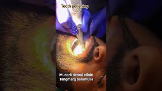 #toothpolishing part 1 #toothcleaning #toothfilling #asmrpolishing #asmrvideos #dentalpolishing ###