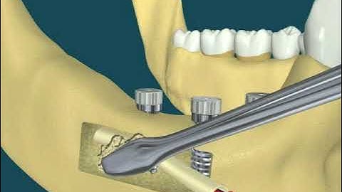 Dental video of Nerve Repositioning