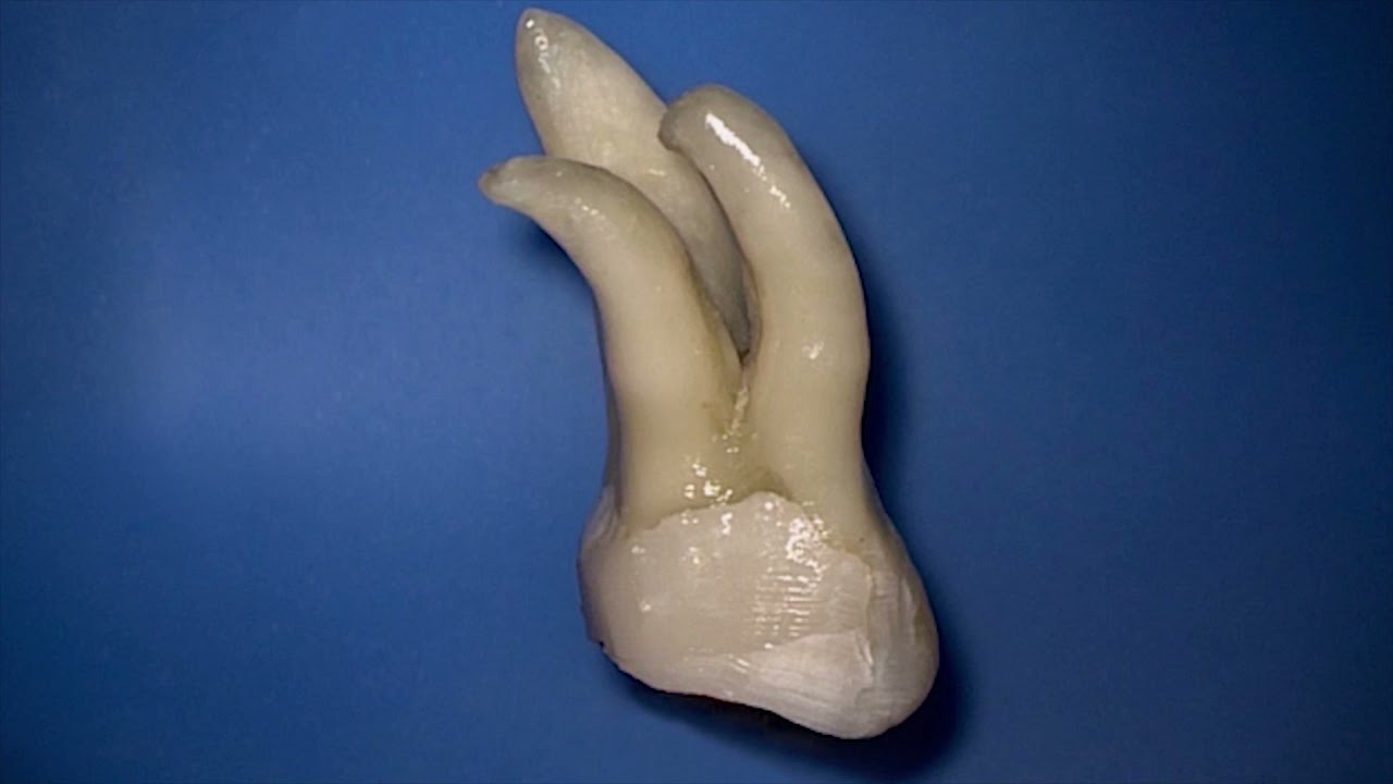 Secured Root Canal Treatment using Dentsply Protaper NiTi Rotary Files | pinkblue