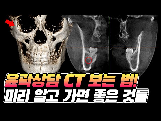 안면윤곽 상담 CT사진 보는 법! 미리 알고 가면 좋은 것들