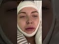 #ортогнатическаяоперация #члх #брекеты #дистальныйприкус