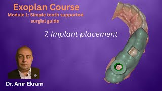 7  Implant placement in Exoplan