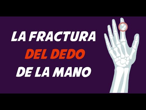 Vídeo: Síntomas, Causas, Diagnóstico Y Tratamiento De Fractura En La Mano