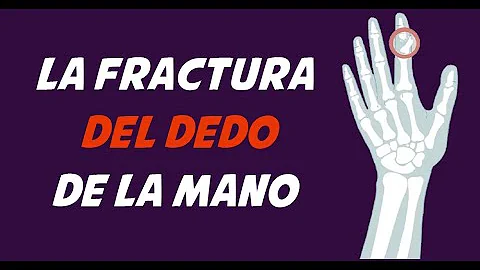 ¿Es dolorosa la rotura de un dedo?