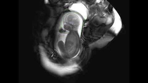 Fetal face detection in MRI using Viola&Jones detector from OpenCV