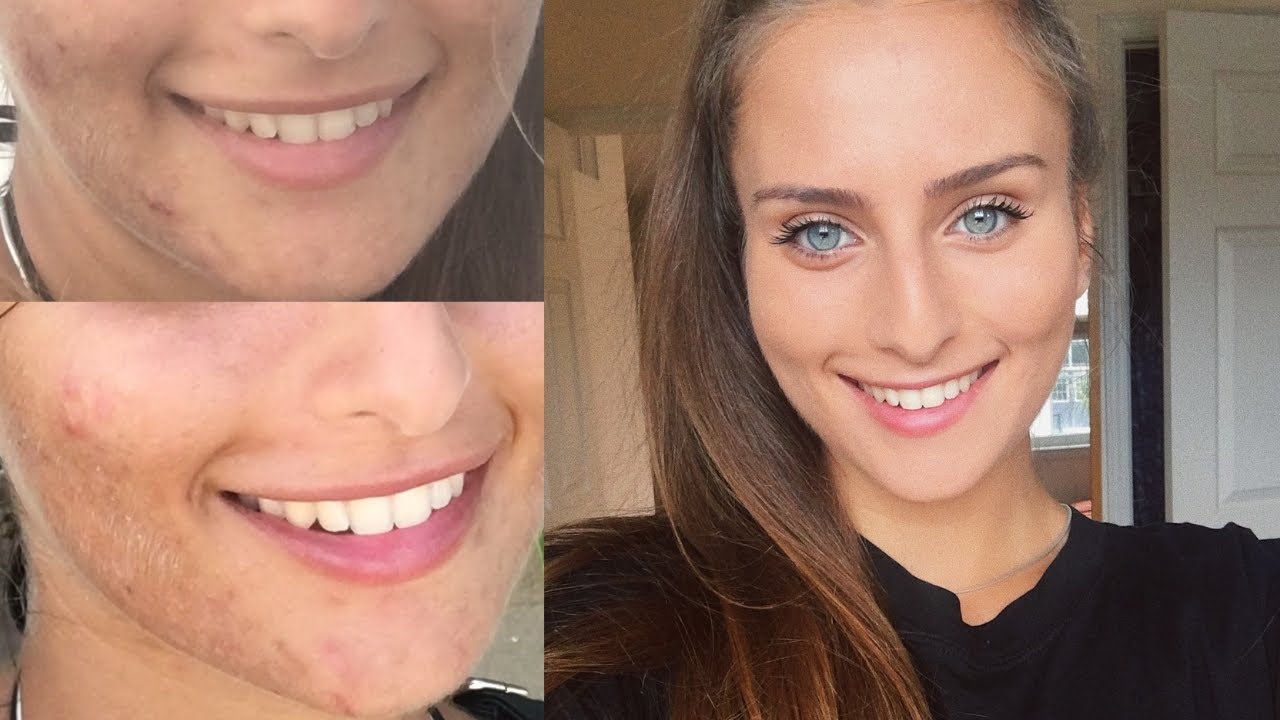 How I finally cleared my skin from acne - My 12 years of struggle - YouTube