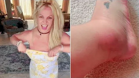 Britney Spears SHOWS OFF Swollen ankle, Britney spears blames mom for hotel drama!