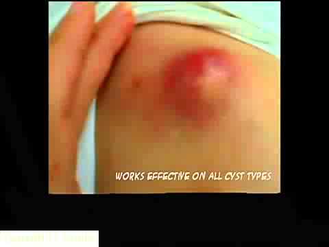 Sebaceous Cyst Home Treatment - % GUARANTEE Effective! - Garrett H Smith