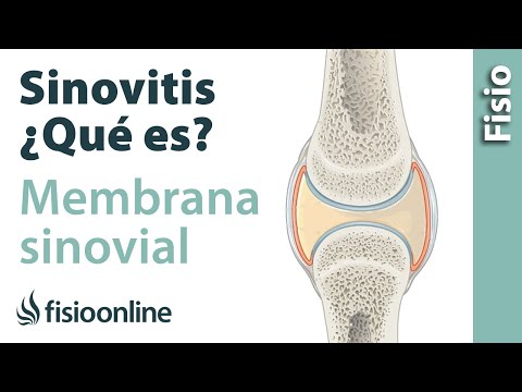 Vídeo: Control De La Sinovitis Articular Para La Regeneración De Hueso Y Cartílago En La Artritis Reumatoide