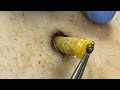 [ASMR] Sharp Ingrown Trimmed! Professional Pedicure DR LEE’S ULTIMATE ZITPOPPER 2010m1 3159