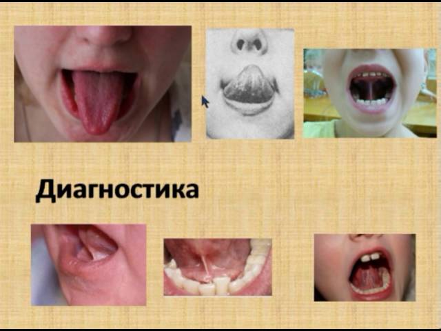 Короткая уздечка языка. Когда нужно подрезать?