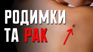 Чи може родимка перетворитися на рак? | Клятий раціоналіст