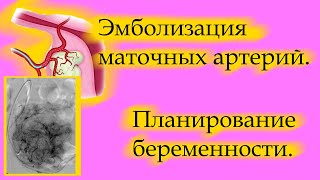 МИОМА: Эмболизация маточных артерий. Последствия. Планирование беременности.