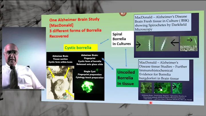 NonSpiral Borrelia Part 1 Explanation of Shape shifting and Form Metamorphosis of Spirochetes