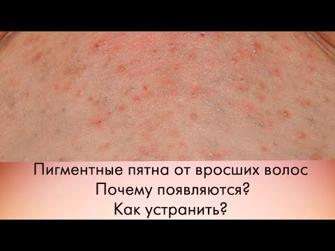 Как избавиться от вросших волос и предотвратить проблему пигментации?