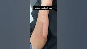إزالة التاتو بجهاز البيكوواي ليزر 