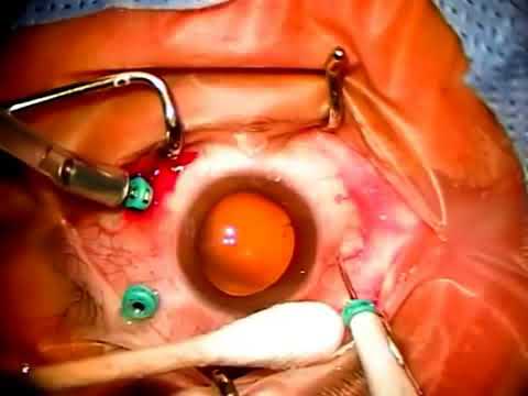 تحضير العين لاجراء عملية قص السائل الزجاجي جراحة الشبكية